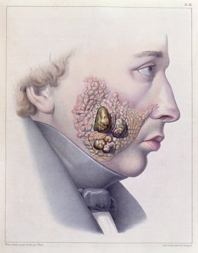 The facial symptoms of venereal disease, from Traite Complet des Maladies Veneriennes by Philippe Ricord by French School