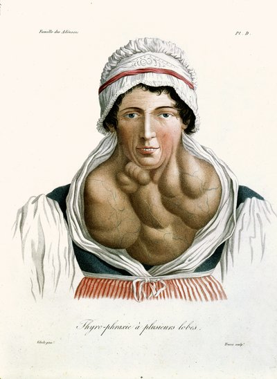Thyroid disease, from a book by Baron Jean Louis Alibert 1817 by French School