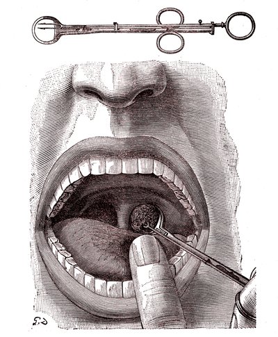 Tonsillectomy by French School