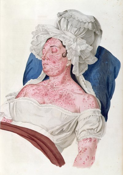 Woman with scarlet fever, from a book by Baron Jean Louis Alibert engraved by Choupard, 1833 by French School