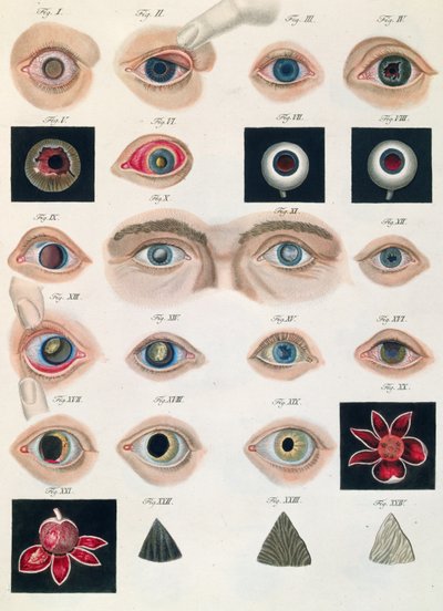 Description of congenital eye anomalies, from Klinische Darstellungen der Krankheiten und Blidungsfehler des Menschlichen Auges, by Friedrich August von Ammon, 1838 by German School