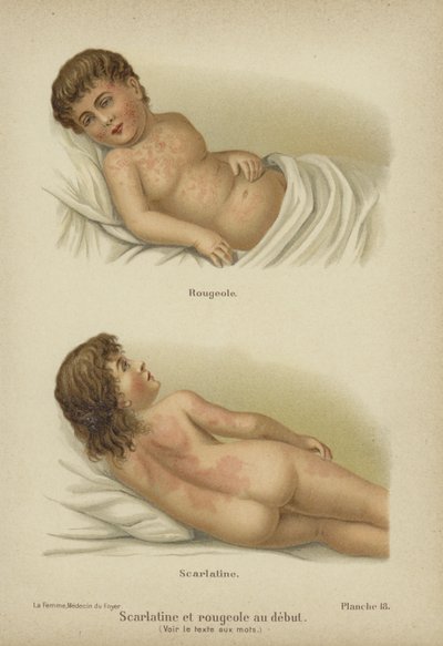Early symptoms of measles and scarlet fever by German School