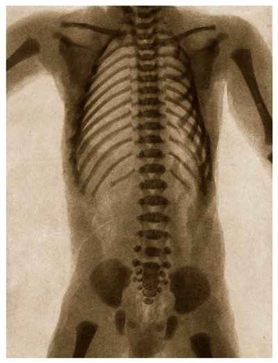 X Ray of a Human Torso by German School