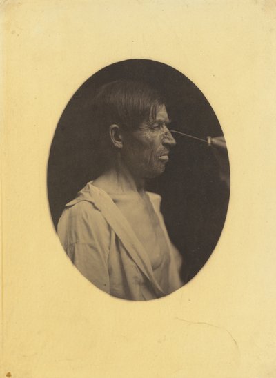 Bad humor, malcontentment by Guillaume-Benjamin-Armand Duchenne de Boulogne
