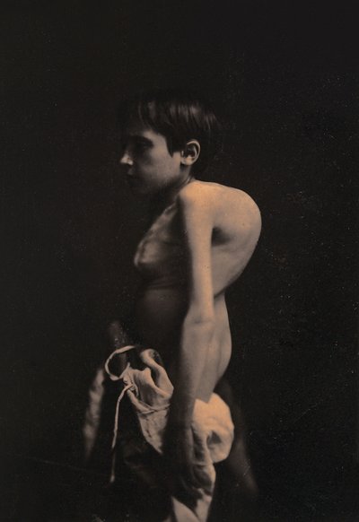 Portrait of a hunchback boy by Guillaume Benjamin Armand Duchenne de Boulogne