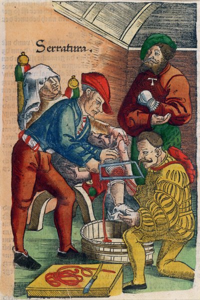 An Amputation, illustration from 
