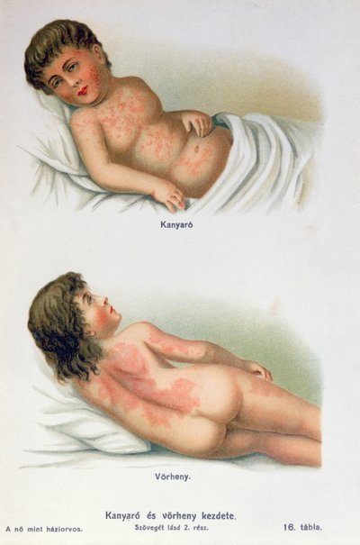Measles and scarlet fever, from a family medical book, c.1900 by Hungarian School