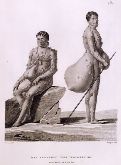 Northern Mariana Islands: Two Men Suffering from Tuberculosis, from 