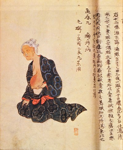 The first surgical treatment of breast cancer performed under general anaesthetic by Seishu Hanaoka in 1804 by Japanese School