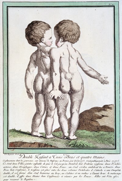 Siamese children - in 
