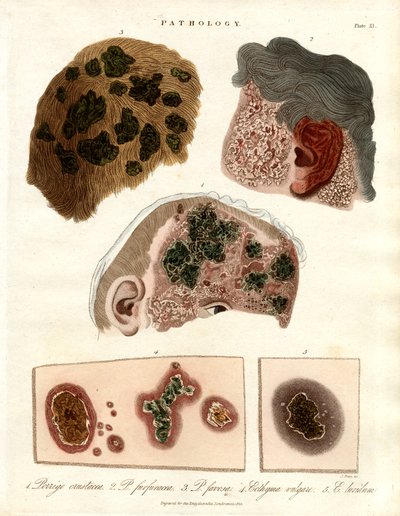Pathological Skin Changes: Porriga and Ecthyma by John Pass