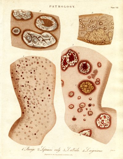 Pathological Skin Conditions: Schurigie, Leprous Skin, Pallada and Impetigo by John Pass