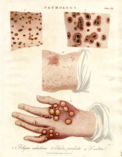 Skin Diseases: Ecthyma, Purulent Scabies, and Smallpox by John Pass