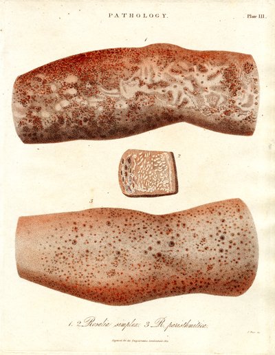 Skin Eruptions - Roseola simplex and Roseola paristhmitica by John Pass