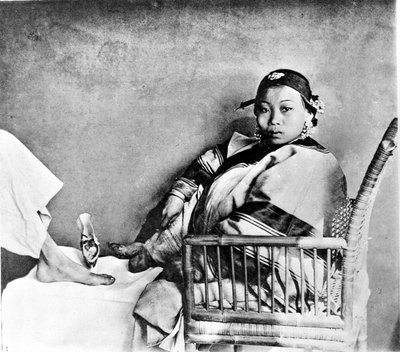 Woman showing her foot mutilated by wearing traditional shoes next to a European foot by John Thomson