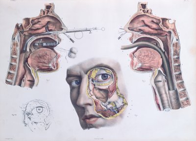 A Nasal Operation, Plate from 
