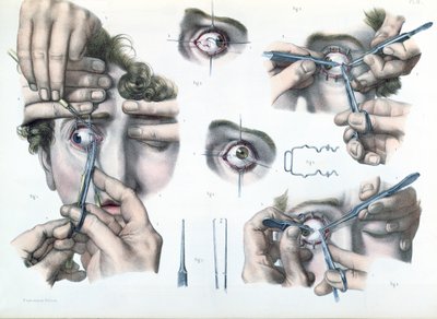 Operation on a strabismus, plate from 