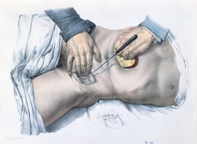 Tying up an artery, plate from 
