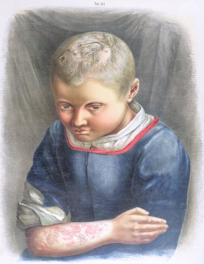 Favus, from a Book by Daniel Cornelius Danielssen, 1892 by Norwegian School