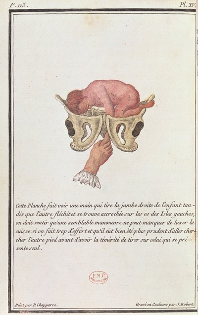 Cross-sectional diagram of a baby pulled from the womb by the arm, from a book by Madame Angelique Le Boursier du Coudray engraved by J. Robert by P. Chapparre
