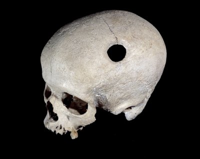Prehistoric skull with trepanation trace, Museum of National Antiquities by Prehistoric Prehistoric