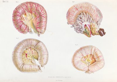 The external surface of the intestines infected with cholera, from Anatomie Pathologique du Cholera Morbus, by Nikolai Ivanovich Pirogov published in St. Petersburg, 1849 by Russian School