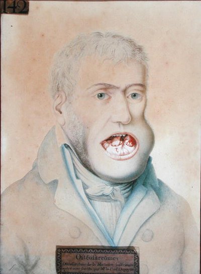 Osteosarcoma of the lower jaw, operated on successfully by Guillaume Dupuytren by School French