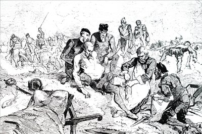 Ambroise Pare tying off arteries after amputation by Unbekannt