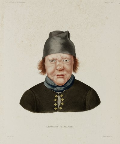 Diseases, Leprosy Female Leper, Iceland, early 19th century by Unbekannt