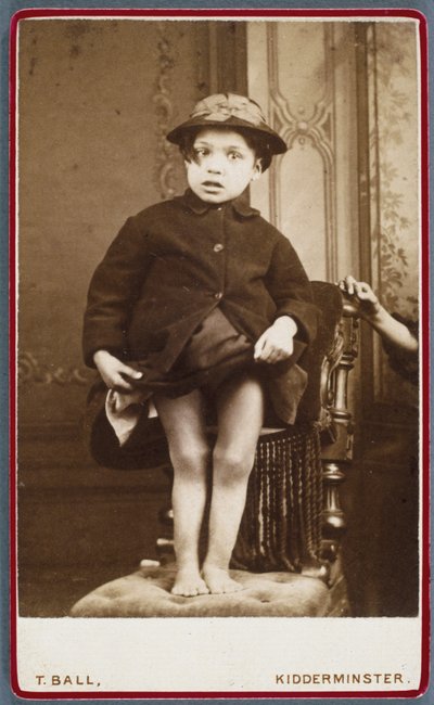 Diseases, Rickets Child with rickets by Unbekannt