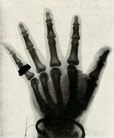 Radiograph of the Hand of H.R.H. The Prince of Wales by Unbekannt