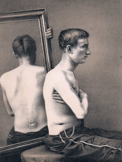 Recovering Casualty of a Bullet Wound to the Abdomen, American Civil War by Unbekannt