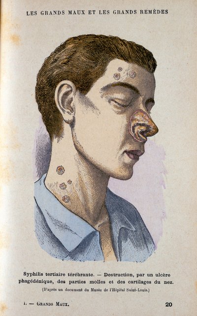 Symptoms of the Tertiary Phase of Syphilis, 19th century by Unbekannt