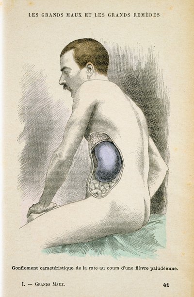 Typical Enlarged Spleen of a Malaria Patient by Unbekannt