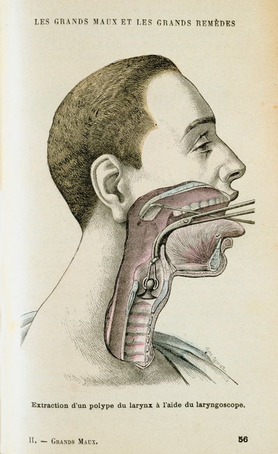 Using a Laryngoscope to Aid the Removal of a Polyp from the Throat by Unbekannt
