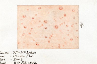 Diseases, Chickenpox by Unbekannt