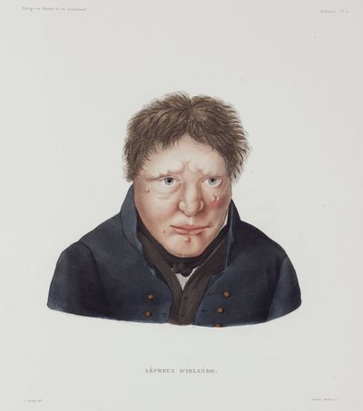 Diseases, Leprosy Male leper, Iceland, early 19th century by Unbekannt