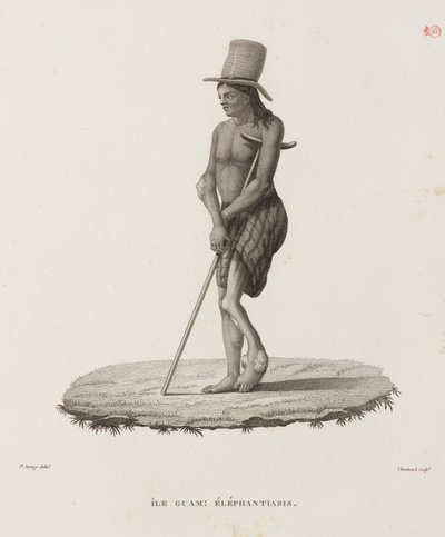 Diseases, Tropical Diseases Man with elephantiasis, Guam by Unbekannt