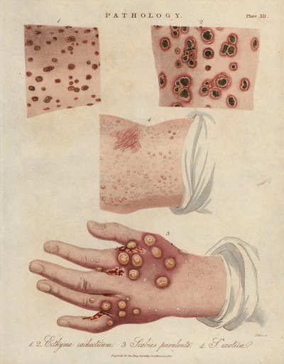 Skin Ulcer and Scabies by Unbekannter Künstler