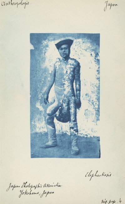Elephantiasis by Unknown 19th Century