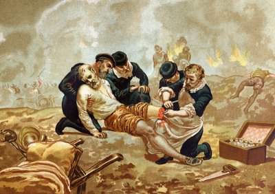 Ambroise Pare Medic and French surgeon (c. 1509-1590) practices ligation of arteries after amputation. from 