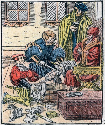 Amputation of a leg in the 16th century. by Unknown artist
