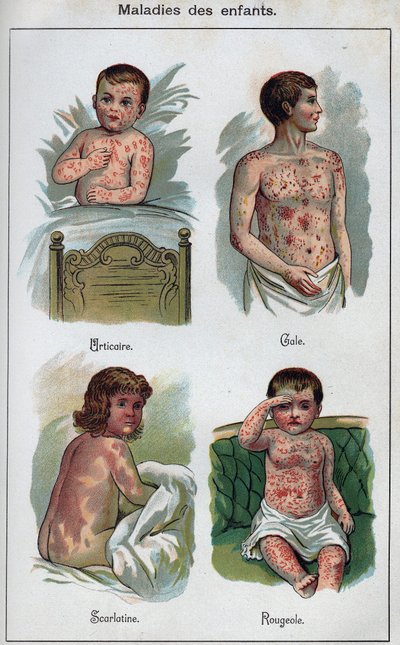 Diseases of children: Hives, Measles, scabies, scarlet fever. In 