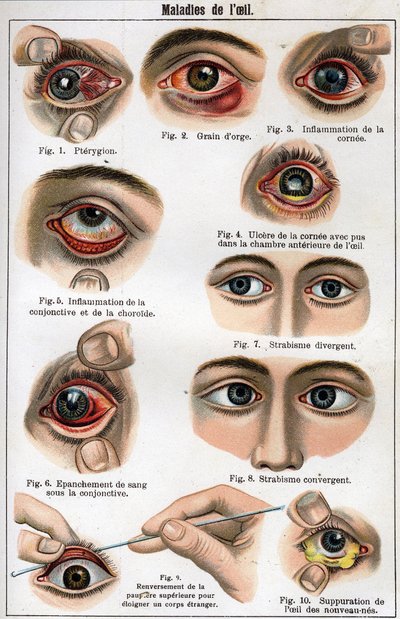 Diseases of the Eye. 