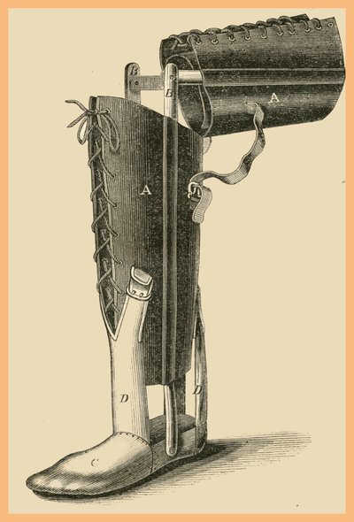 Leg Replacement by Unknown Artist