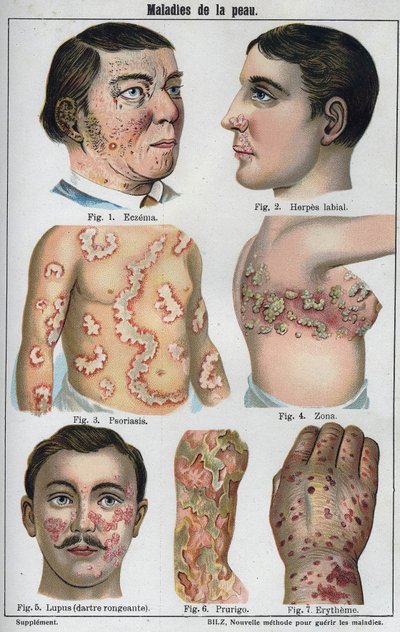 Skin diseases: Eczema, labial herpes, psoriasis, shingles, lapus (rotting darter), prurigo, erytheme. 