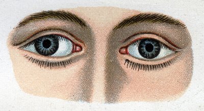 Strabismus divergent. 