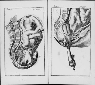 Birth of a Baby with Use of Forceps by Unknown artist