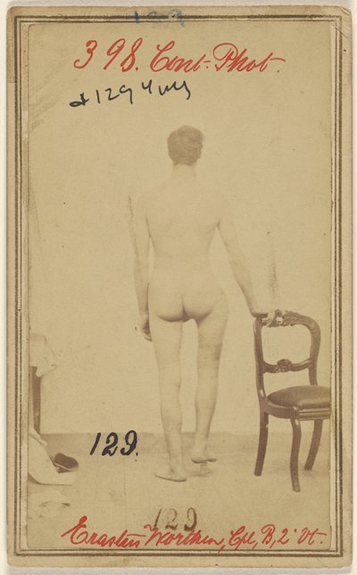Fracture of the Upper Third of the Femur, Erastus Worthen, Corp Co. B. 2nd Vermont Vols, Aged 25, Residence Stockbridge VT by Unknown artist