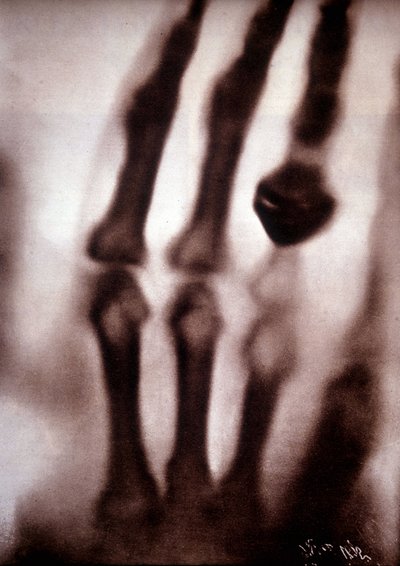 Roentgen rays or X-rays First photograph: the hand of Roentgen